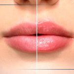 عوارض استفاده از حجم دهنده لب | ۸ روش های پیشگیری از این عوارض