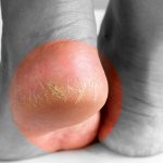 پاشنه پای ترک خورده؛ آیا کمبود ویتامین C دلیل آن است؟